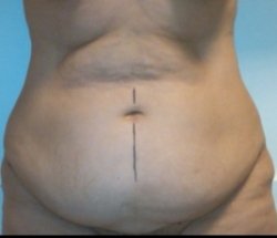 Manhattan abdominoplasty before 3